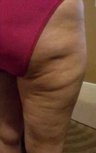 cos'è la cellulite